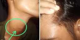 Diduga Mantan Oknum Kades Pukul dan Cekik Warga Nya Hingga Memar, Korban Lapor Polisi